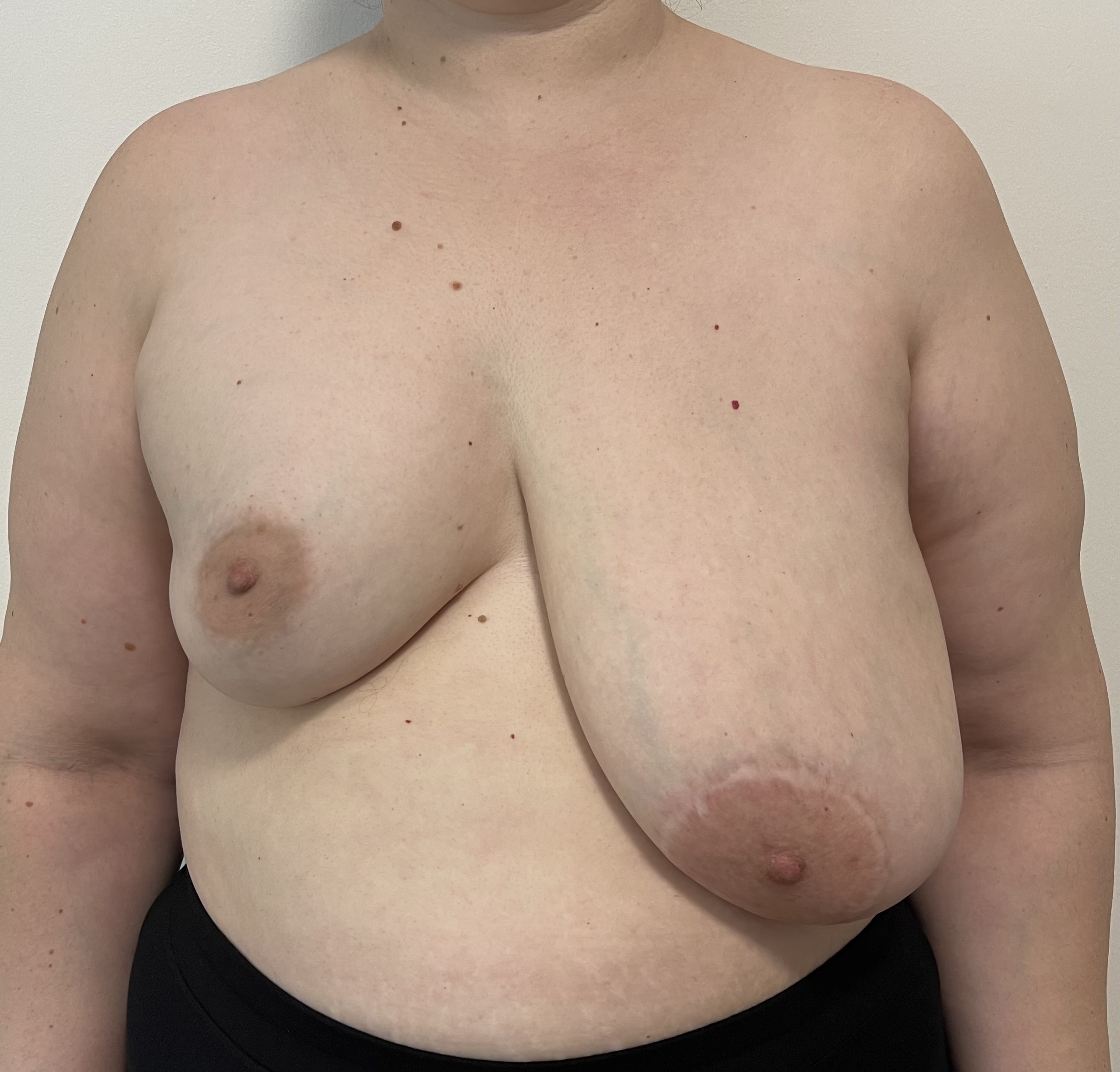 Before — MD asymmetry Lt reduction R ex